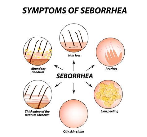 ' <b>Seborrheic</b> <b>dermatitis</b> can also affect other. . Seborrheic dermatitis cure permanent